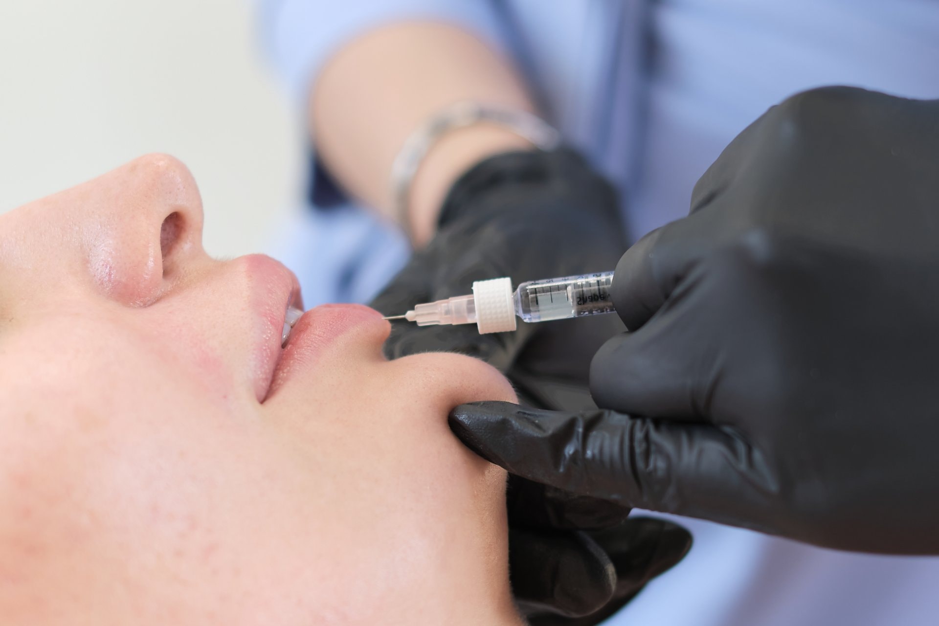 Hyaluron pen vs. klasični fileri: razlike, rizici i šta odabrati